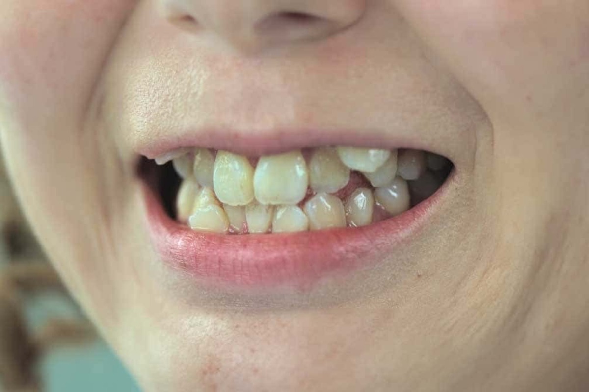 歯並びが悪くなる5つの習慣＆予防方法